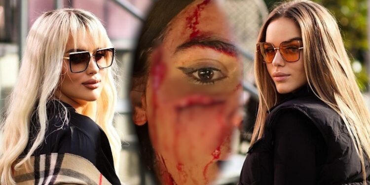 Dhunuan rëndë 24-vjeçaren në një restorant të Tiranës, policia shpall në kërkim Antolena Berishën dhe motrën e saj