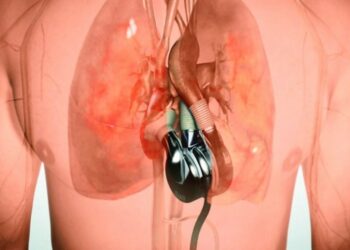 100 ditë me zemër artificiale! Australiani jetoi mbi 3 muaj me pajisjen eksperimentale